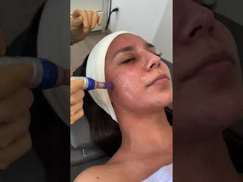 Microneedling 😮😬💉 | Evoclinic